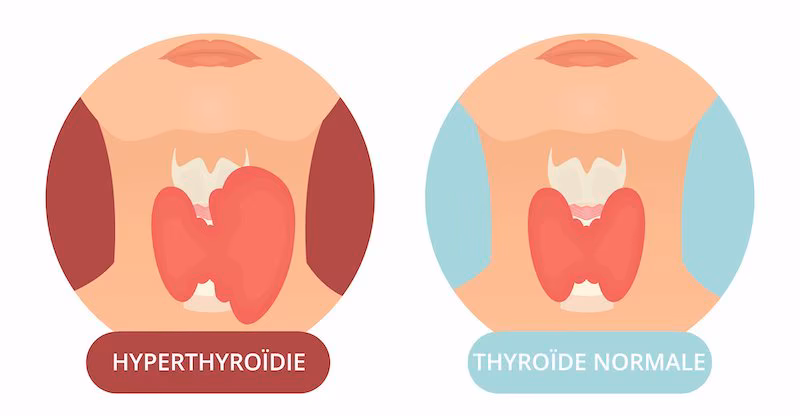 hyperthyroïdie schéma