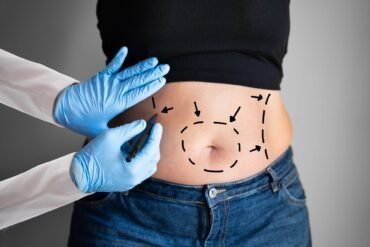 Tout savoir sur la liposuccion du ventre liposuccion-ventre