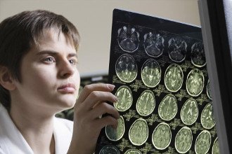 Lien entre le surpoids et la sclérose en plaques