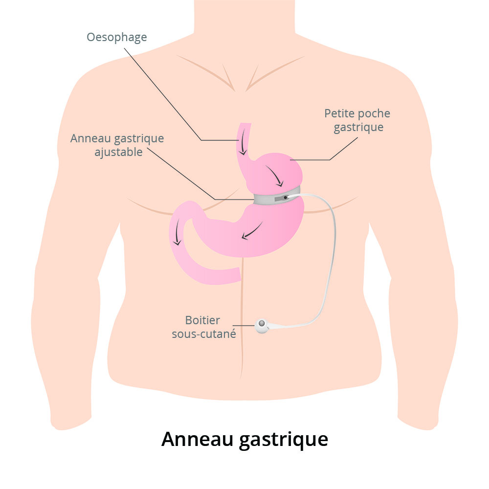 anneau gastrique schéma