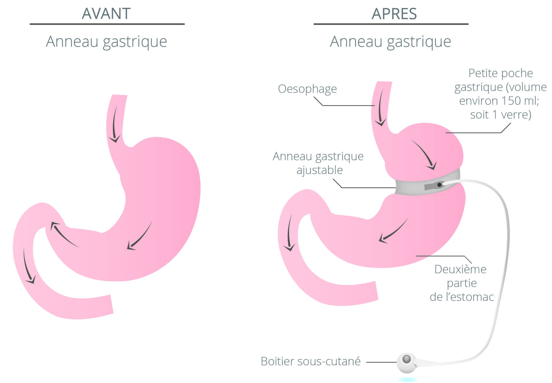 anneau gastrique