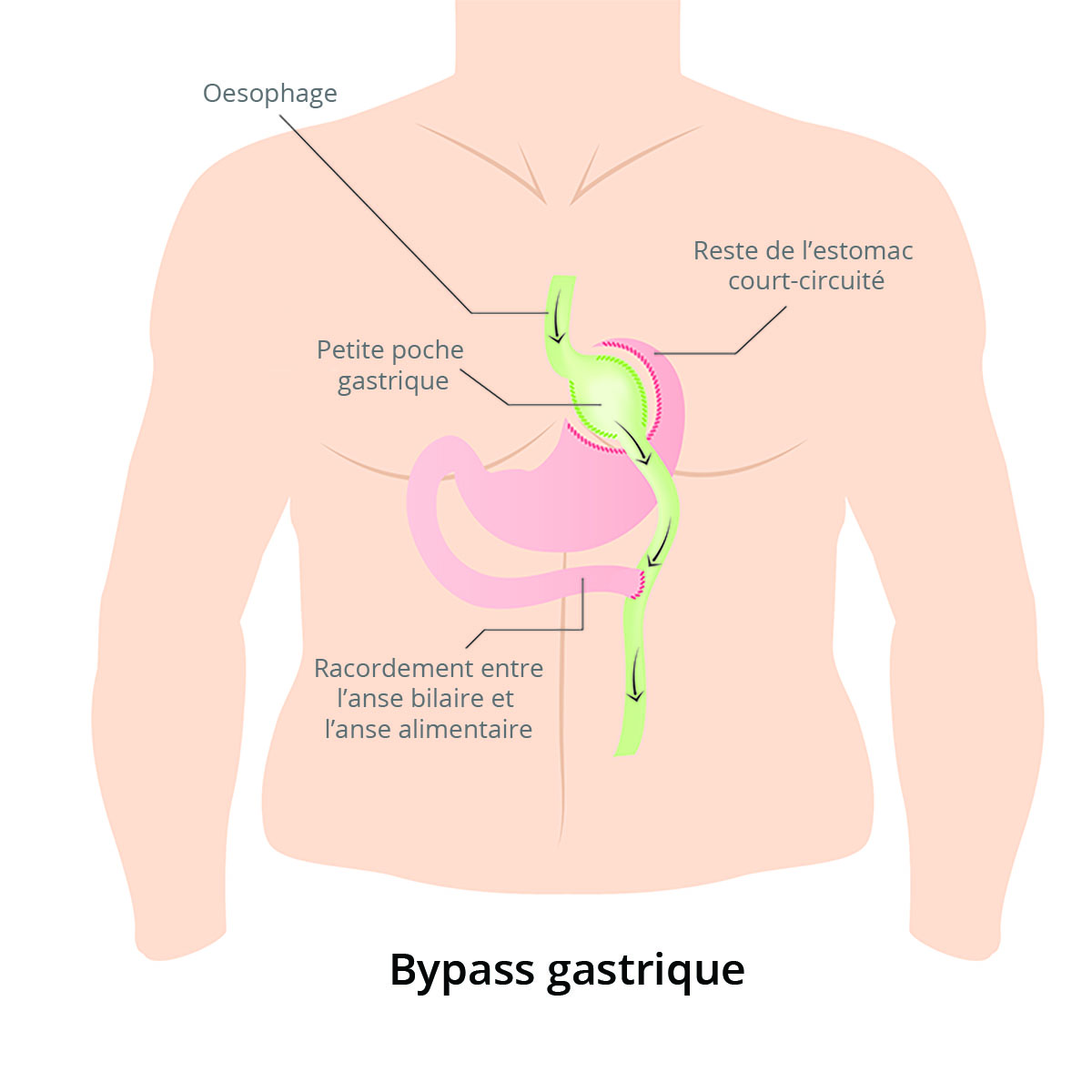 bypass gastrique schéma