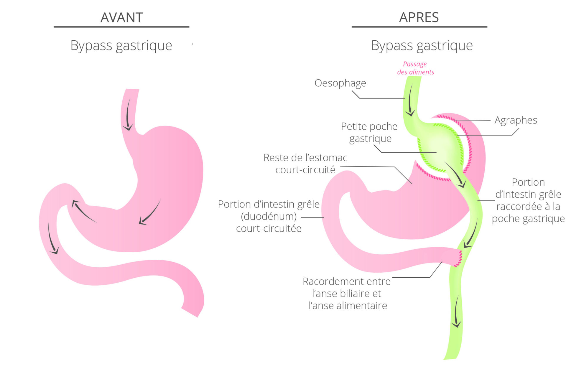 bypass gastrique