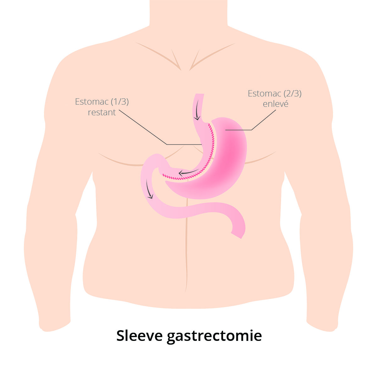 sleeve gastrectomie schéma