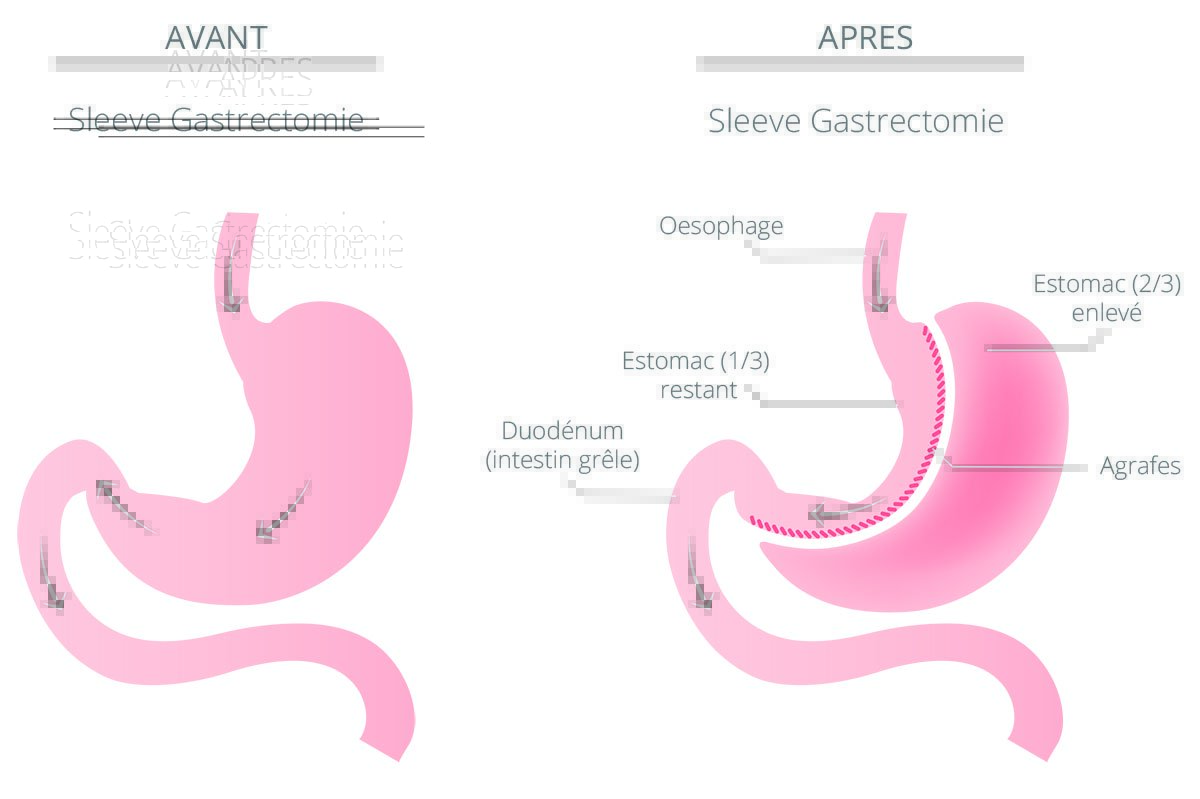 sleeve gastrectomie