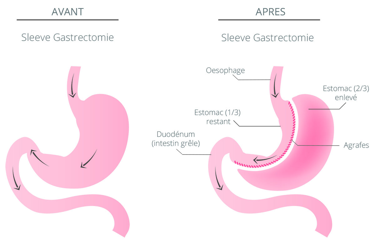 sleeve gastrectomie