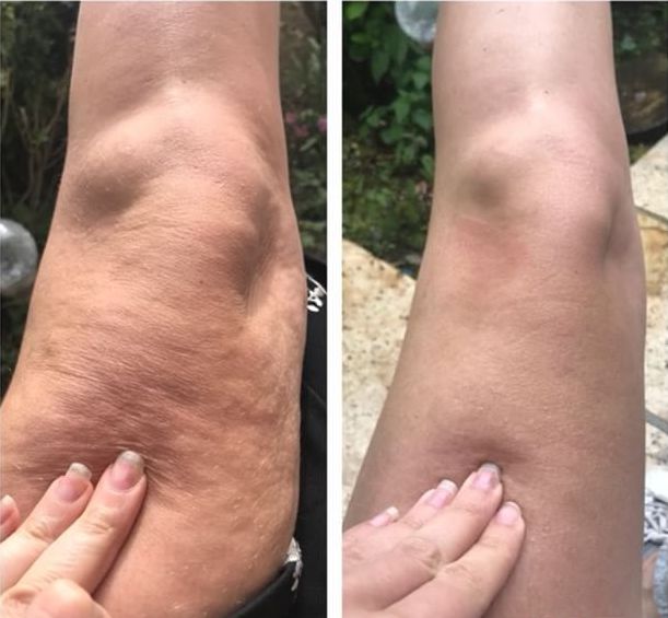 Cellulite behandlung wels Cellulite behandlung wels