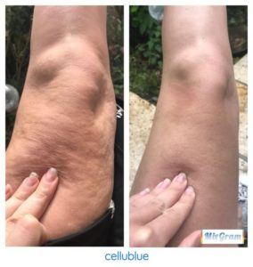 https://www.calculersonimc.fr/wp-content/uploads/2019/02/avant-apre%CC%80s-utilisation-de-la-ventouse-anti-cellulite-cellublue-284x300.jpg