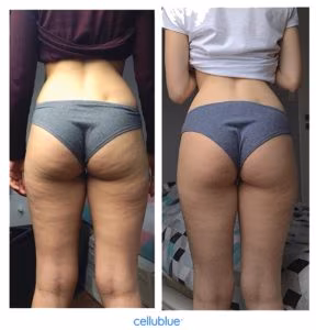 avant après ventouse