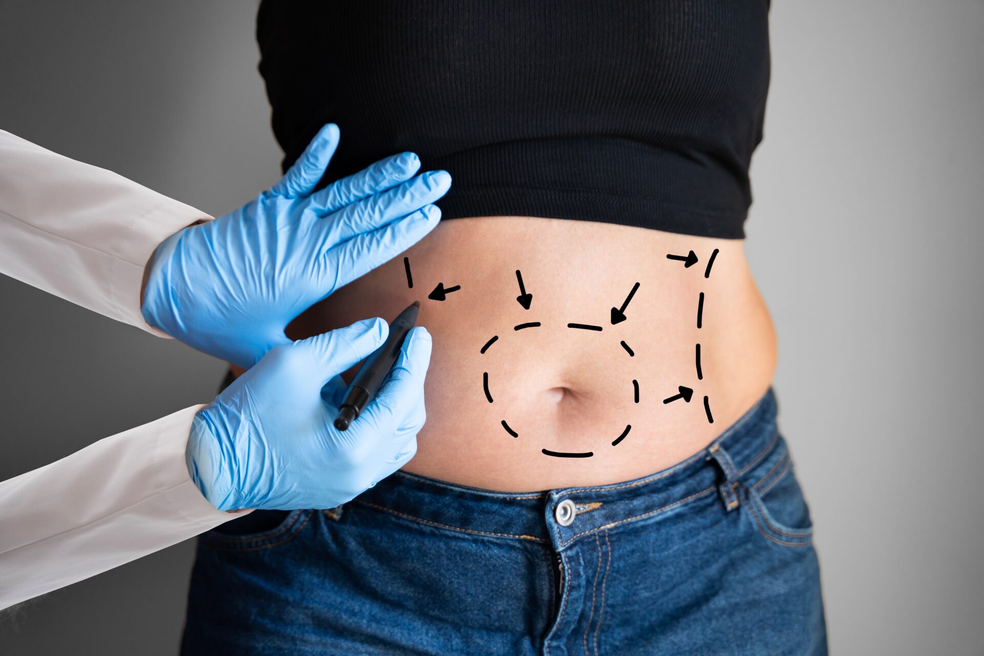 Tout savoir sur la liposuccion du ventre - CalculerSonIMC